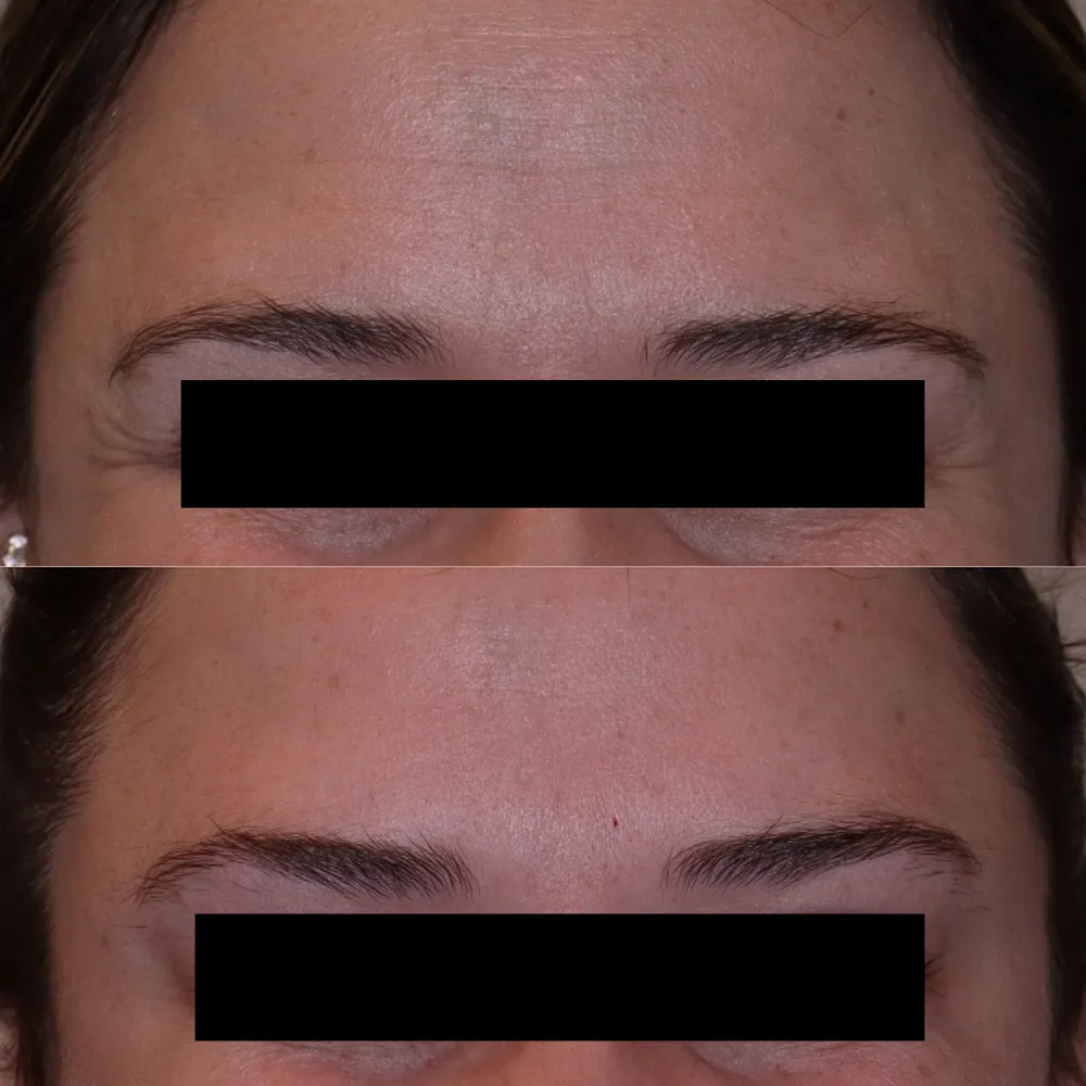 Brow lines treated with toxin