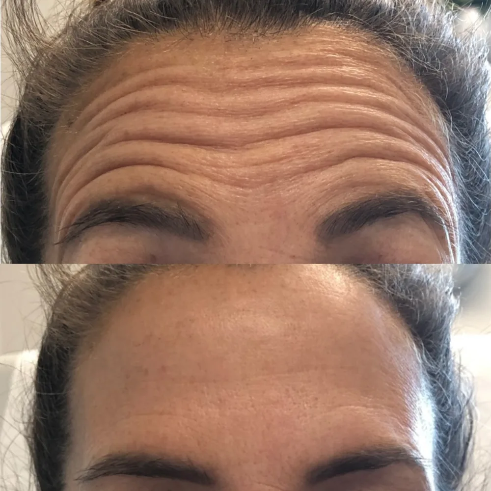 Deep forehead lines softened