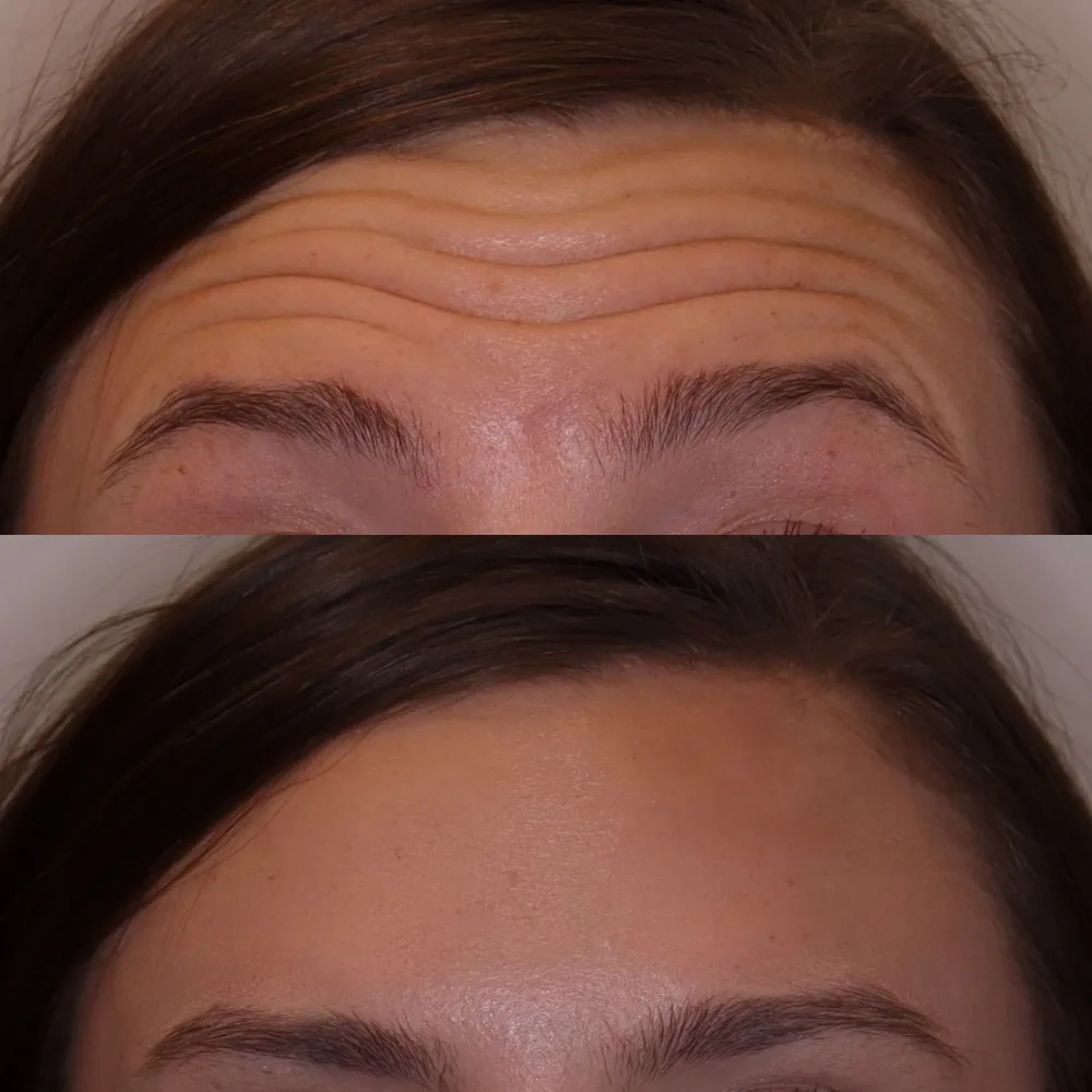 Forehead lines smoothed with Botox