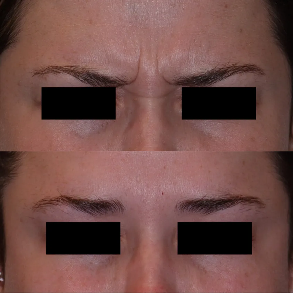 Frown lines softened with Botox