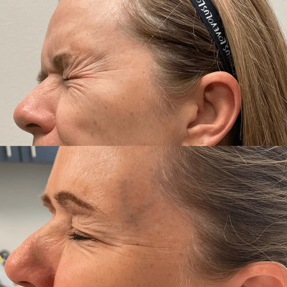 Crow's feet softened with Botox