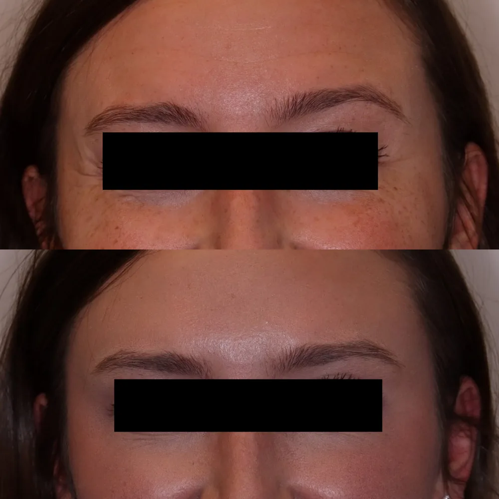 Smoother brow area after toxin