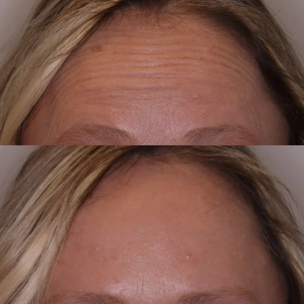 Forehead toxin results