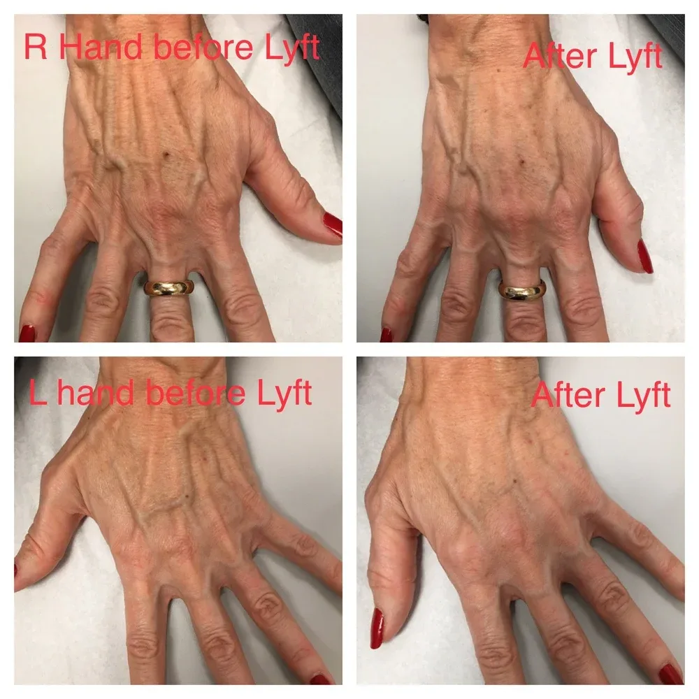 Hand rejuvenation with Restylane Lyft