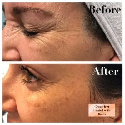 Crow's feet treated with Botox