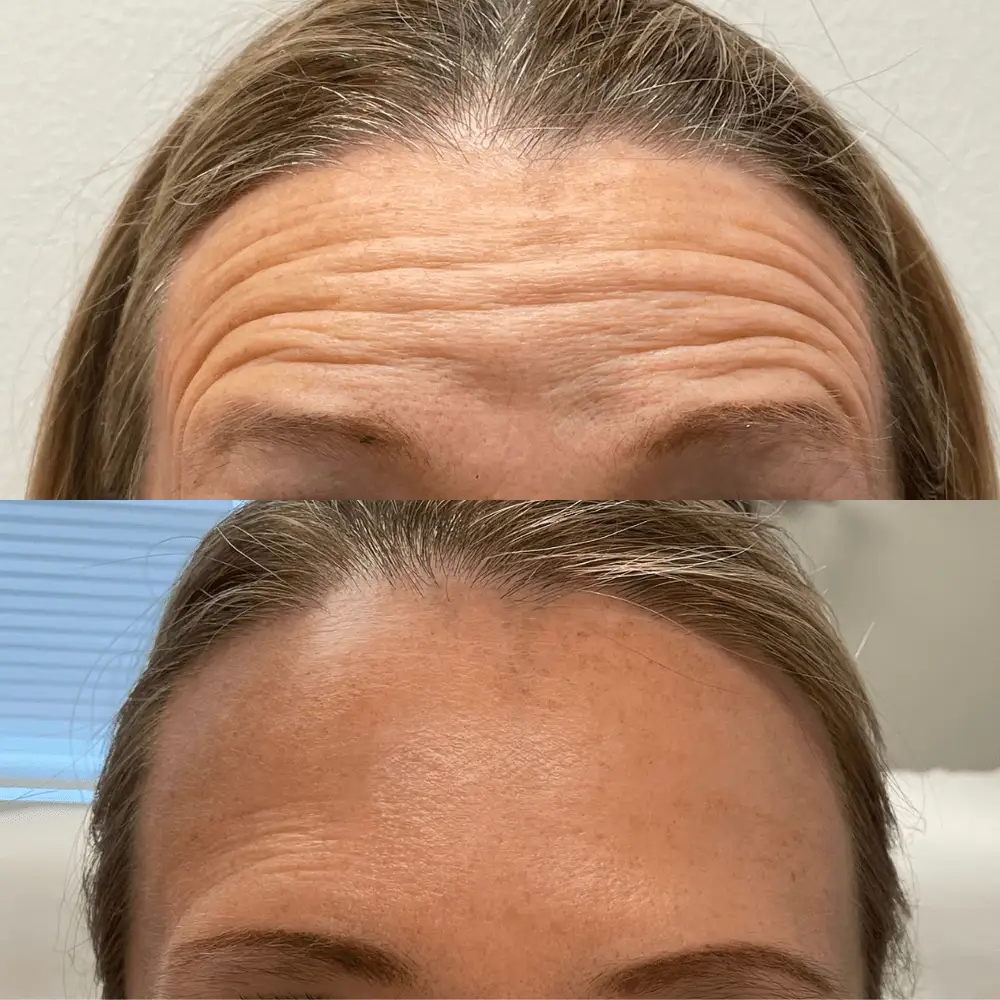 Forehead lines after Botox