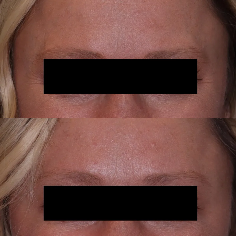 Brow area after toxin treatment