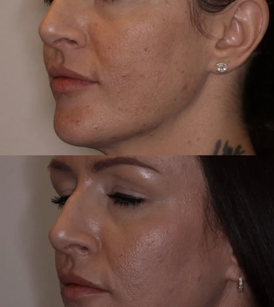 Cheek and jawline contour with filler