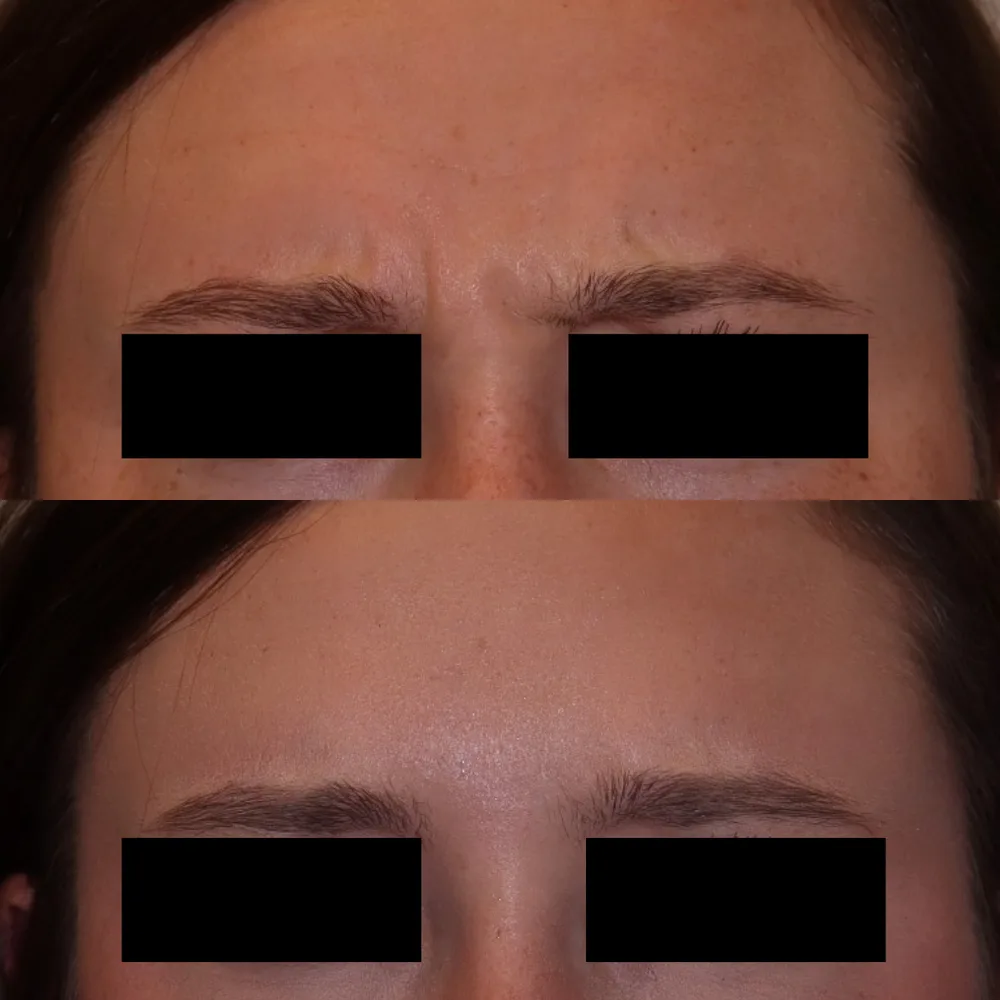 Frown lines before and after Botox