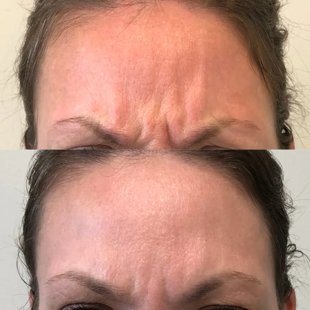 Glabella (11s) relaxed with toxin