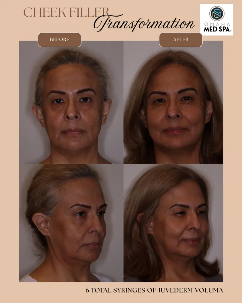 Cheek filler transformation with Juvederm Voluma
