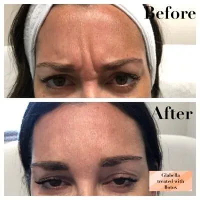 Glabella treated with Botox