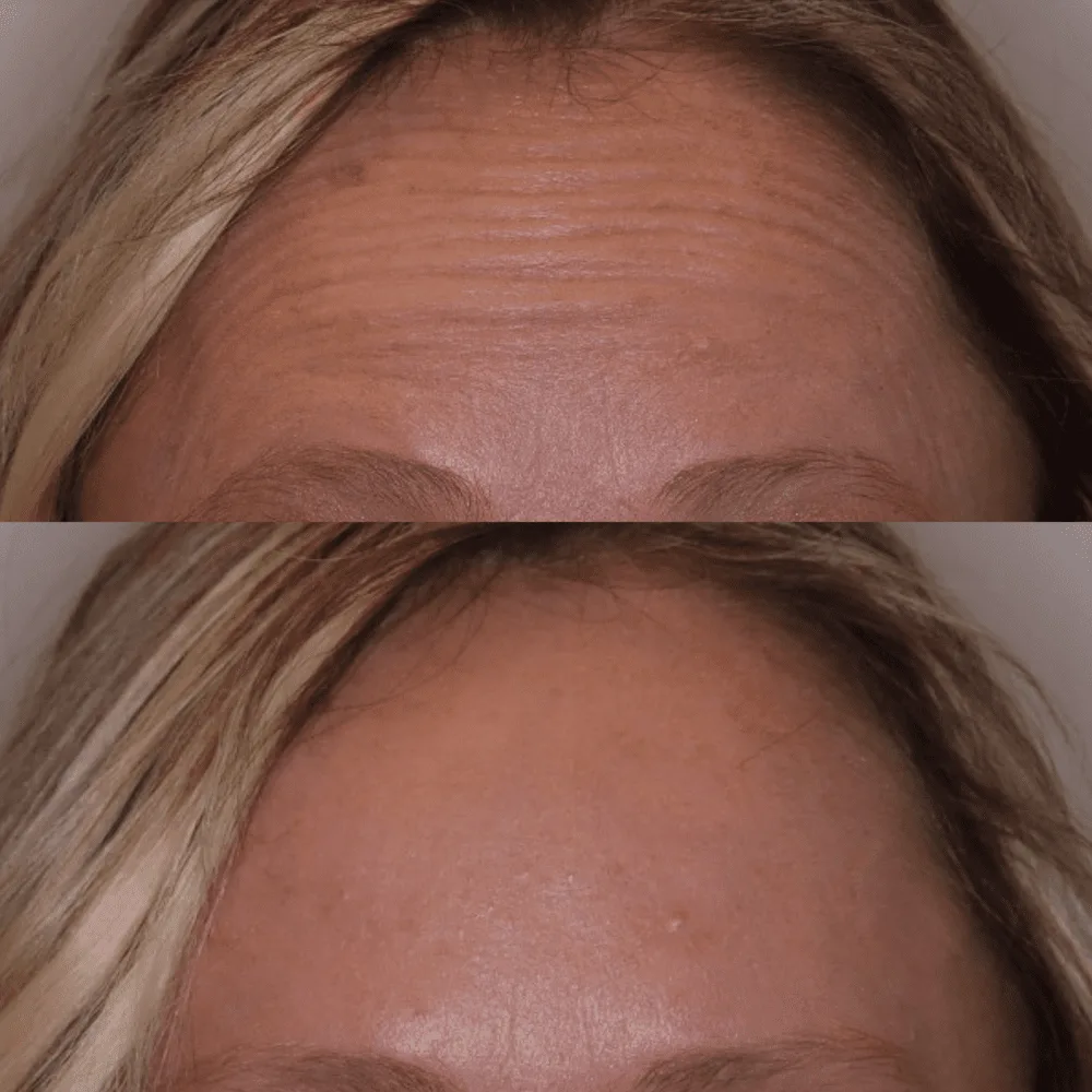 Fine forehead lines smoothed