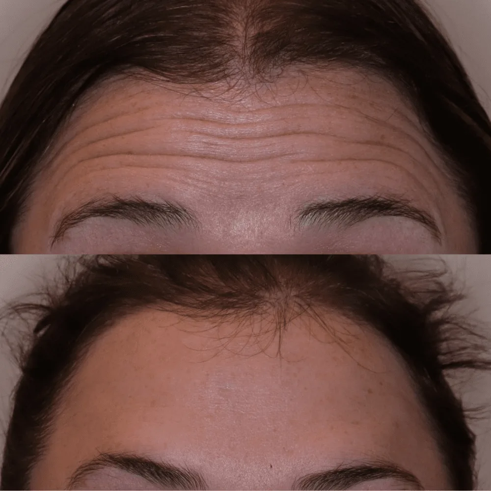 Forehead lines before and after toxin