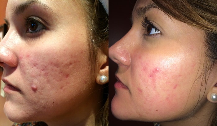 pmd microderm before and after