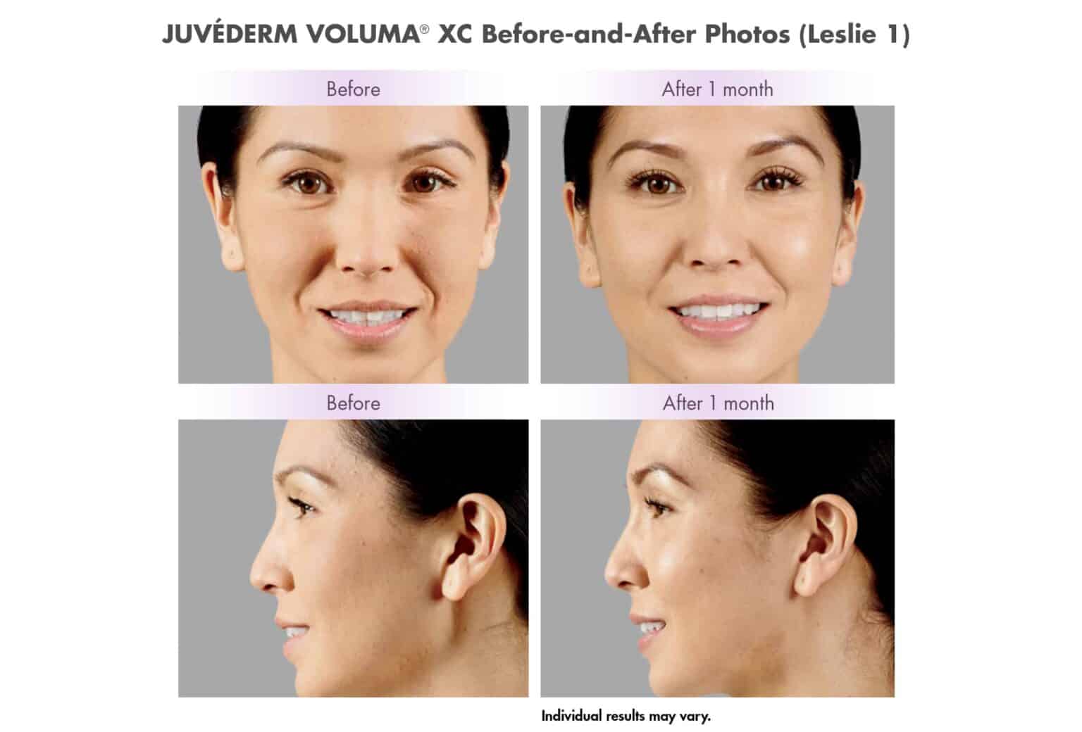 Juvederm Voluma отзывы до и после фото нижняя треть лица