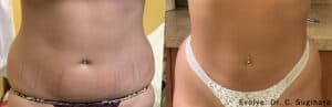 before and after Evolve Tite treatment to the abdomen