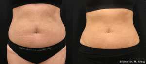 before and after Evolve abdomen