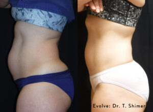 before and after skin tightening, fat burn