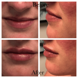 Before and After Restylane Kysse lip filler