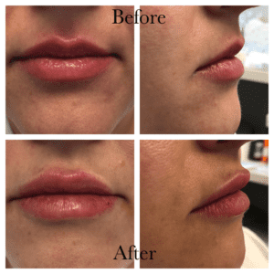 before and after Juvederm Ultra lip filler