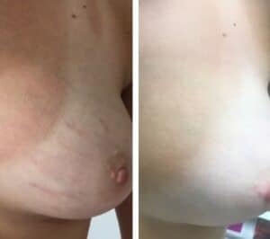 Before and After IPL skin tightening of strech marks on the breast