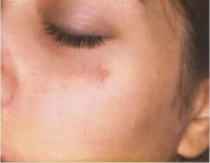 Broken blood vessel, telangiectasia spider vein on face before IPL treatment