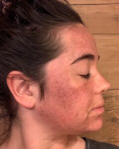 Day 1 post TCA chemical peel for brown sun damaged skin