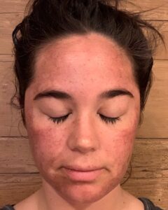 Day 1 Post TCA chemical peel frontal view