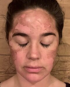 Day 2 post TCA chemical peel frontal view