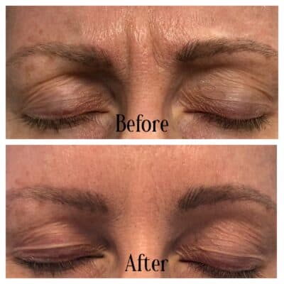 Before above and after below toxin injection to the glabella (frown lines)
