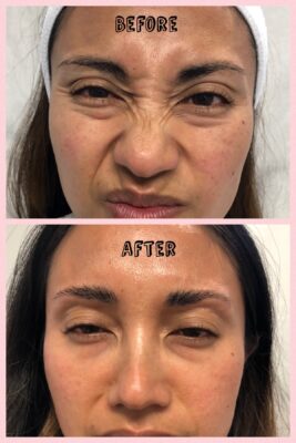 Frown lines and bunny lines on the nose before and after treatment