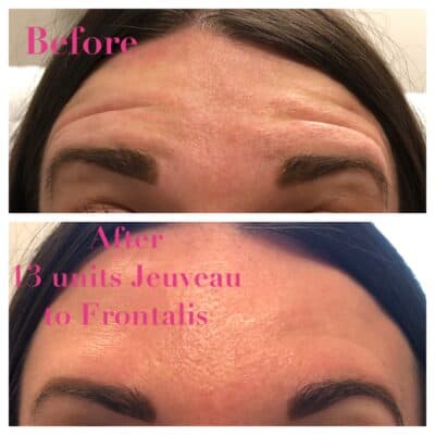 Before and after Jeuveau to the forehead