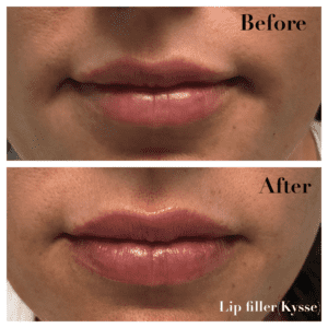 Before and After Lip filler