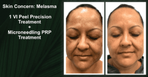VI Peel Precision Plus before and after with SkinPen and PRP