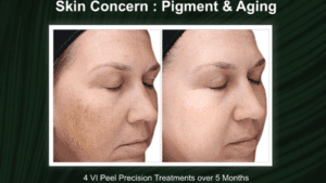 VI Peel Presion Plus before and after pictures