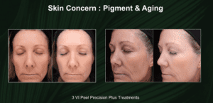 VI Peel Presion Plus before and after pictures