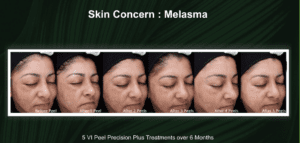 VI Peel Presion Plus for melasma before and after pictures