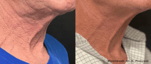 Before and After Morpheus 8 treatment to the Neck, showing skin tightening, reduced wrinkles and improved skin texture