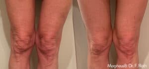 Before and After Morpheus 8 treatment to the area above the knees showing reduction of wrinkles and skin tightening