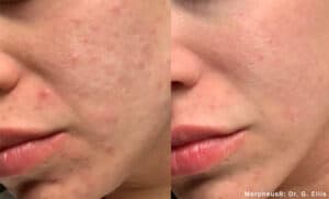 Morpheus 8 acne scar treatment 