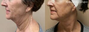 Before and after Morpheus 8 treatment to the face and neck showing dramatic results normally only seen with surgery.