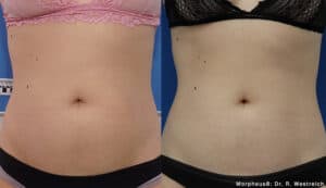 Before and after Morpheus 8 treatment to abdomen - showing fat reduction and skin tightening