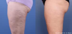 Before and after Morpheus 8 treatment to the thighs showing skin tightening, reduced wrinkles and reduced cellulite.