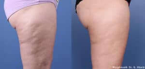 Before and after Morpheus 8 treatment to the thighs showing skin tightening, reduced wrinkles and reduced cellulite.