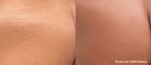 Before and After Morpheus 8 body treatment to buttock showing skin tightening, improvement of stretch marks and reduced cellulite