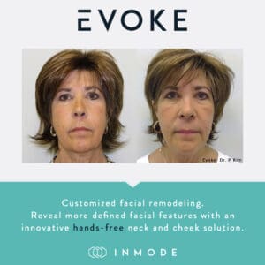 Evoke before and after for jowls and chin