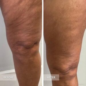 Evolve before and after thighs cellulite and skin laxity
