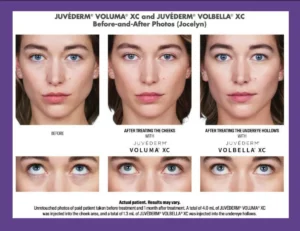 before and after images of Voluma cheek filler and Volbella tear trough filler