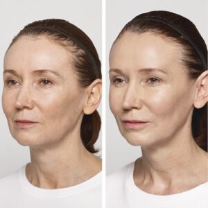before and after images of Lyft filler placed in the cheeks
